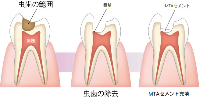 歯髄温存療法(MTA)