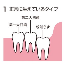 親知らず①