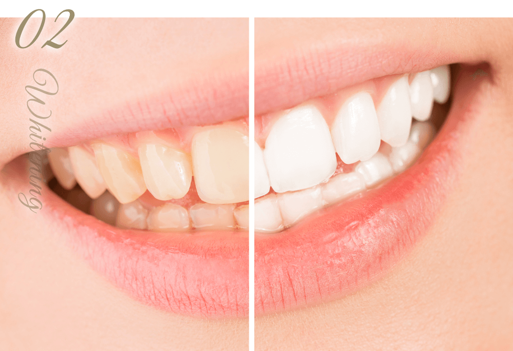 ご自身の歯を白くしたい短期間のホワイトニング