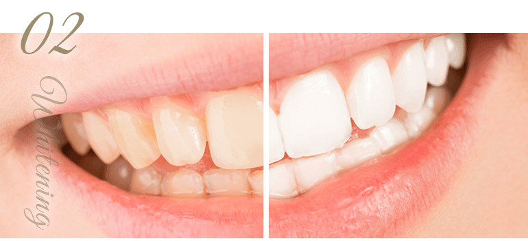 ご自身の歯を白くしたい短期間のホワイトニング
