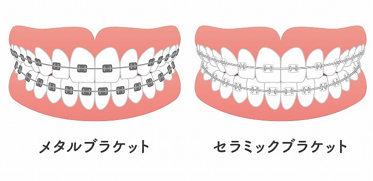 ワイヤー矯正(表側矯正)