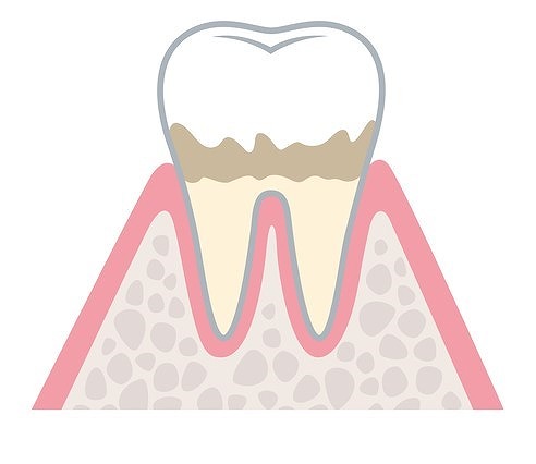 第1段階 歯肉炎