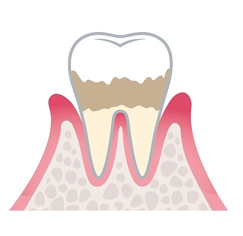 第2段階 軽度歯周炎