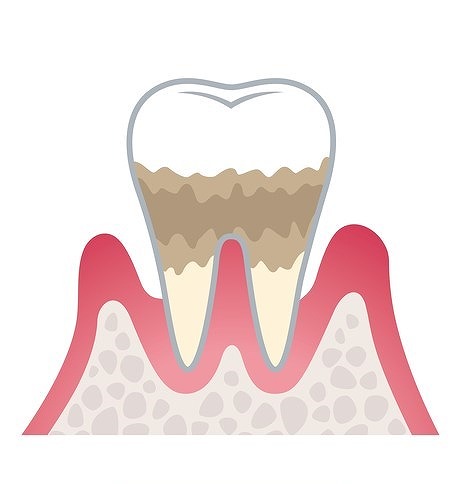 第3段階 中等度歯周炎