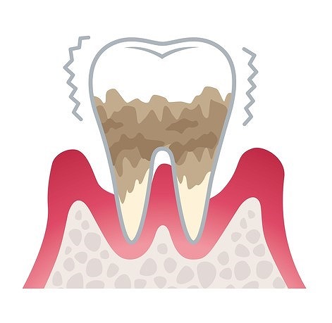 第4段階 重度歯周炎