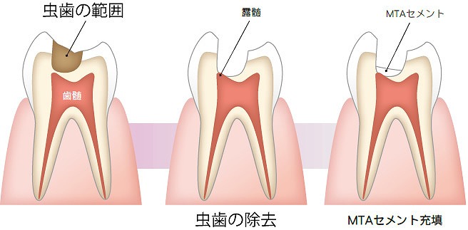 『歯髄温存療法(MTA)』にも対応